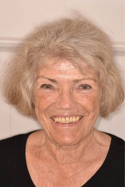 Anne fik sit flotte smil tilbage efter paradentose